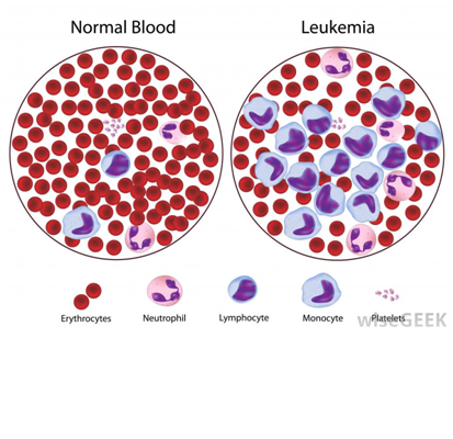 What is Leukemia. Its Type, Etiology, classification;Sign & Symptom,Diagnostic findings, Treatment.