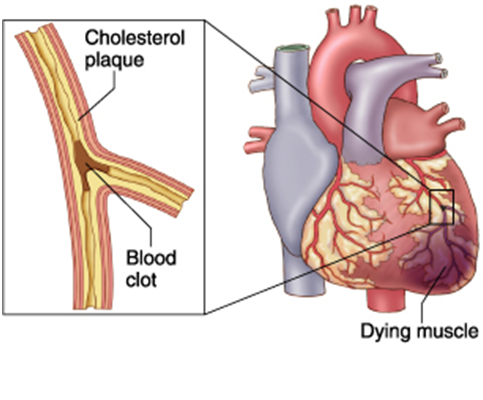 What is Myocardial Infarction & its  pathophysiology  and management ?